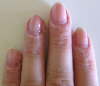 Allergische Reaktion der Haut bei Fingernagel-Modellage
